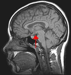 Hypothalamus [WikiCommons]